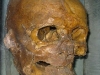 The head of Simon of Sudbury
